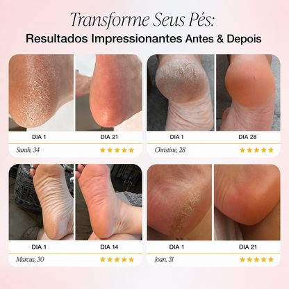 Velura™ Baby Foot – Electric Callus Remover